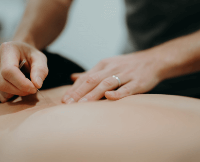 Dry Needling
