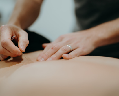 Dry Needling